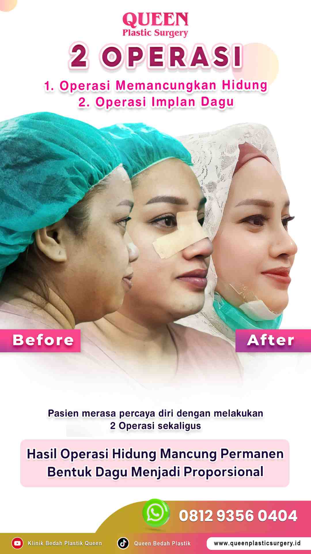 Hasil Rhinoplasty Queen Plastic Surgery, foto 46