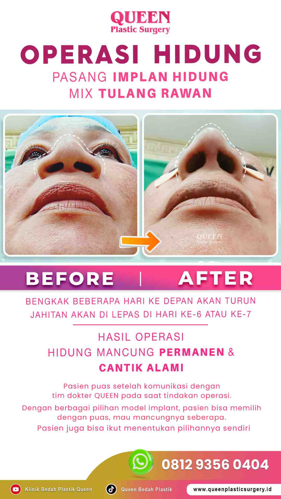 Hasil Rhinoplasty Queen Plastic Surgery, foto 63