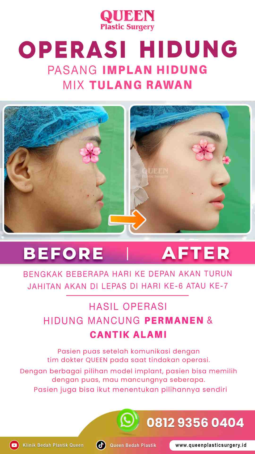 Hasil Rhinoplasty Queen Plastic Surgery, foto 44