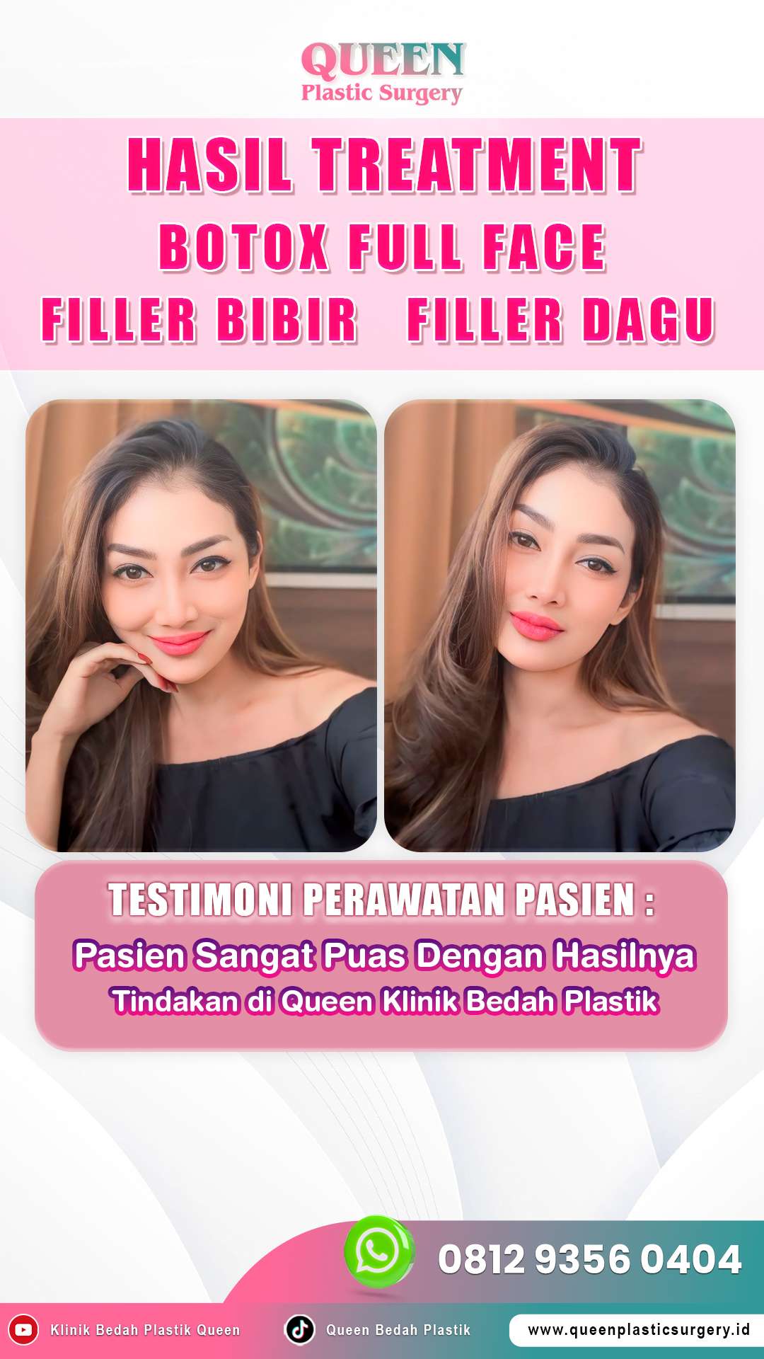 After-Treatment-Pasien-Queen-