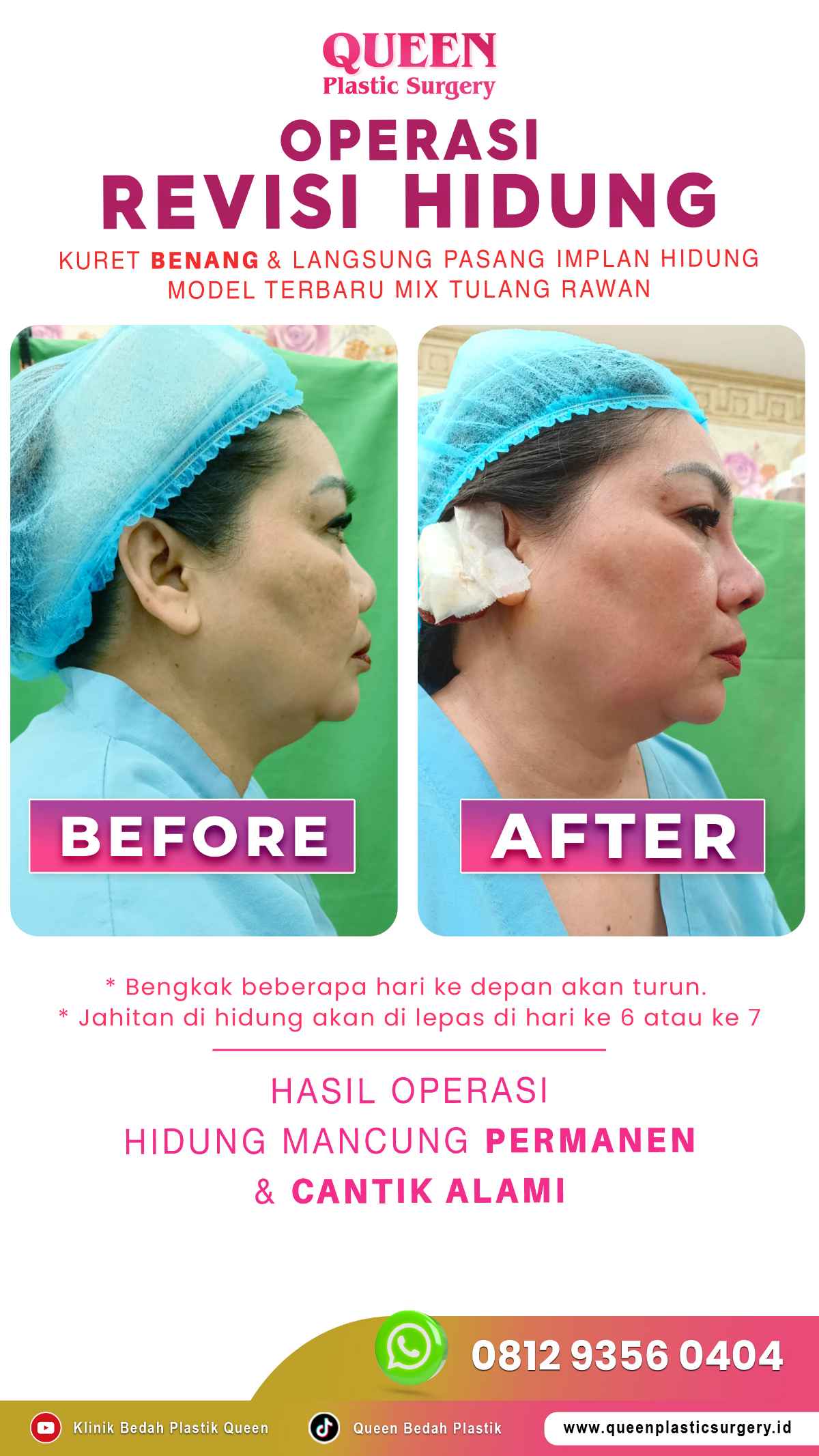 Hasil Rhinoplasty Queen Plastic Surgery, foto 71