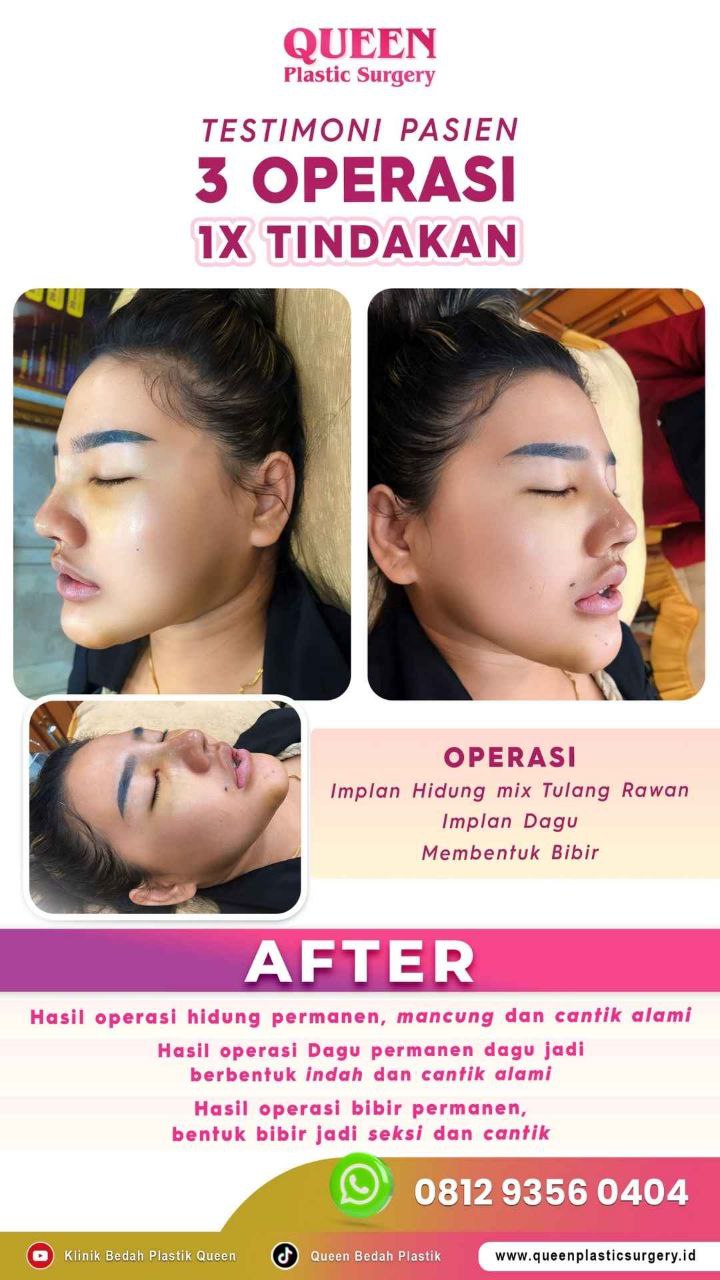 Hasil Rhinoplasty Queen Plastic Surgery, foto 47