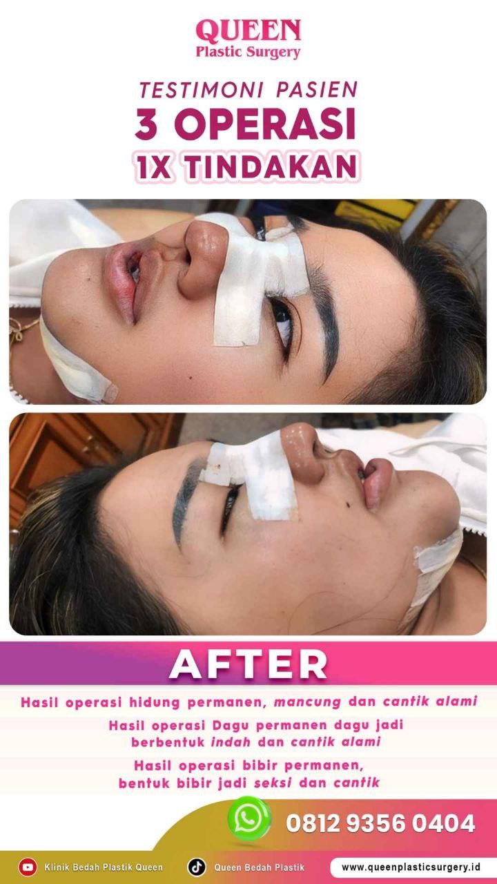 Hasil Rhinoplasty Queen Plastic Surgery, foto 48