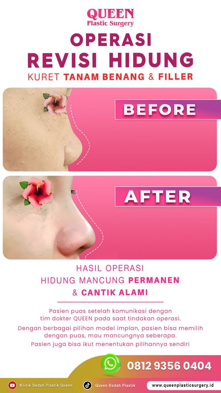 Hasil Rhinoplasty Queen Plastic Surgery, foto 73