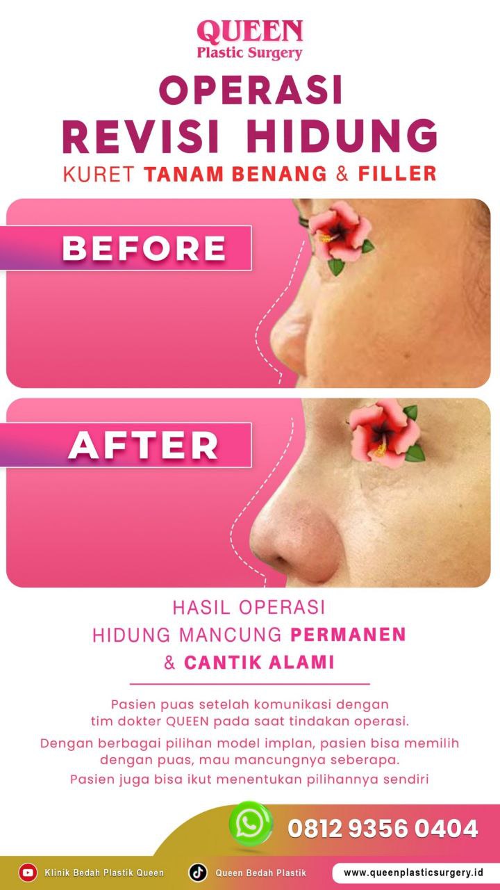 Hasil Rhinoplasty Queen Plastic Surgery, foto 54