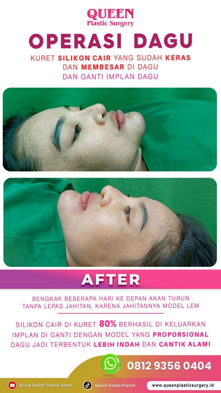 Hasil Rhinoplasty Queen Plastic Surgery, foto 55