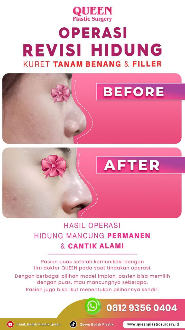 Hasil Rhinoplasty Queen Plastic Surgery, foto 56
