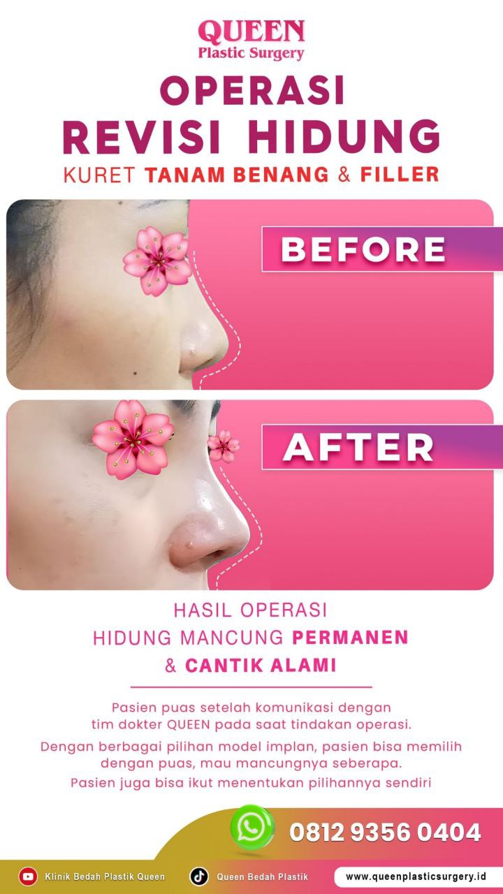 Hasil Rhinoplasty Queen Plastic Surgery, foto 57