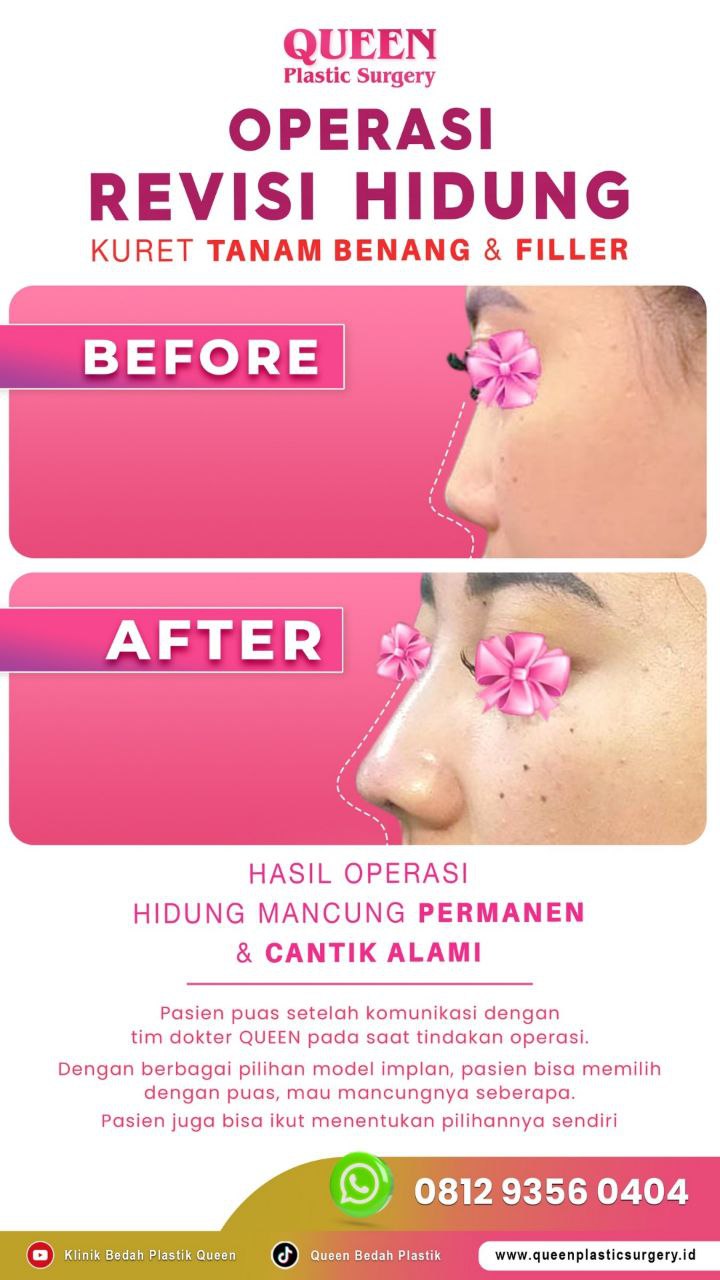 Hasil Rhinoplasty Queen Plastic Surgery, foto 58