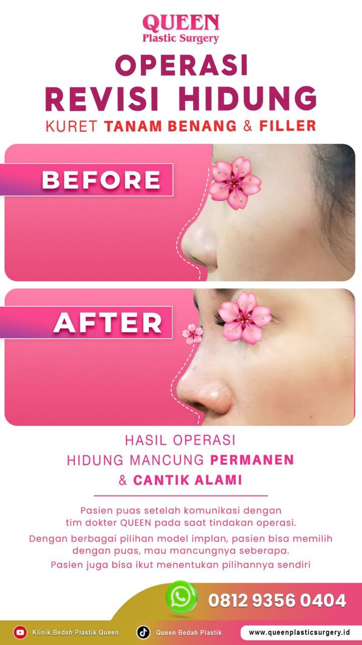 Hasil Rhinoplasty Queen Plastic Surgery, foto 59