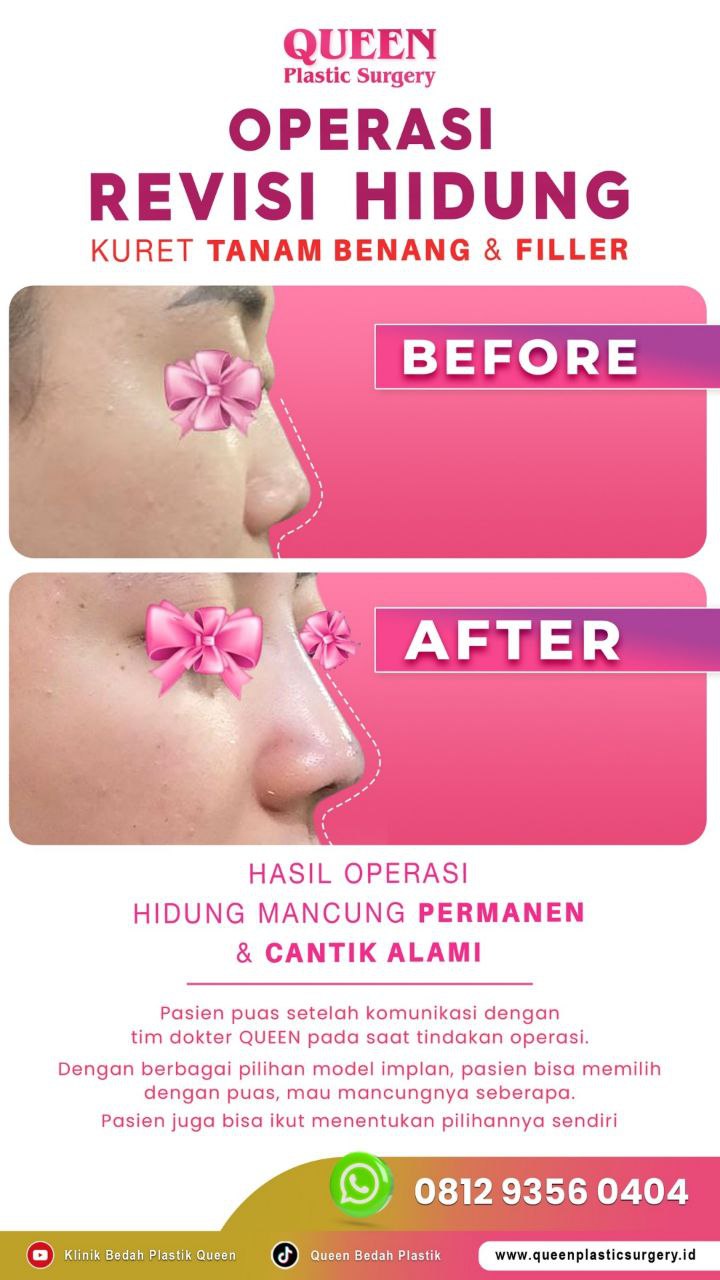 Hasil Rhinoplasty Queen Plastic Surgery, foto 60