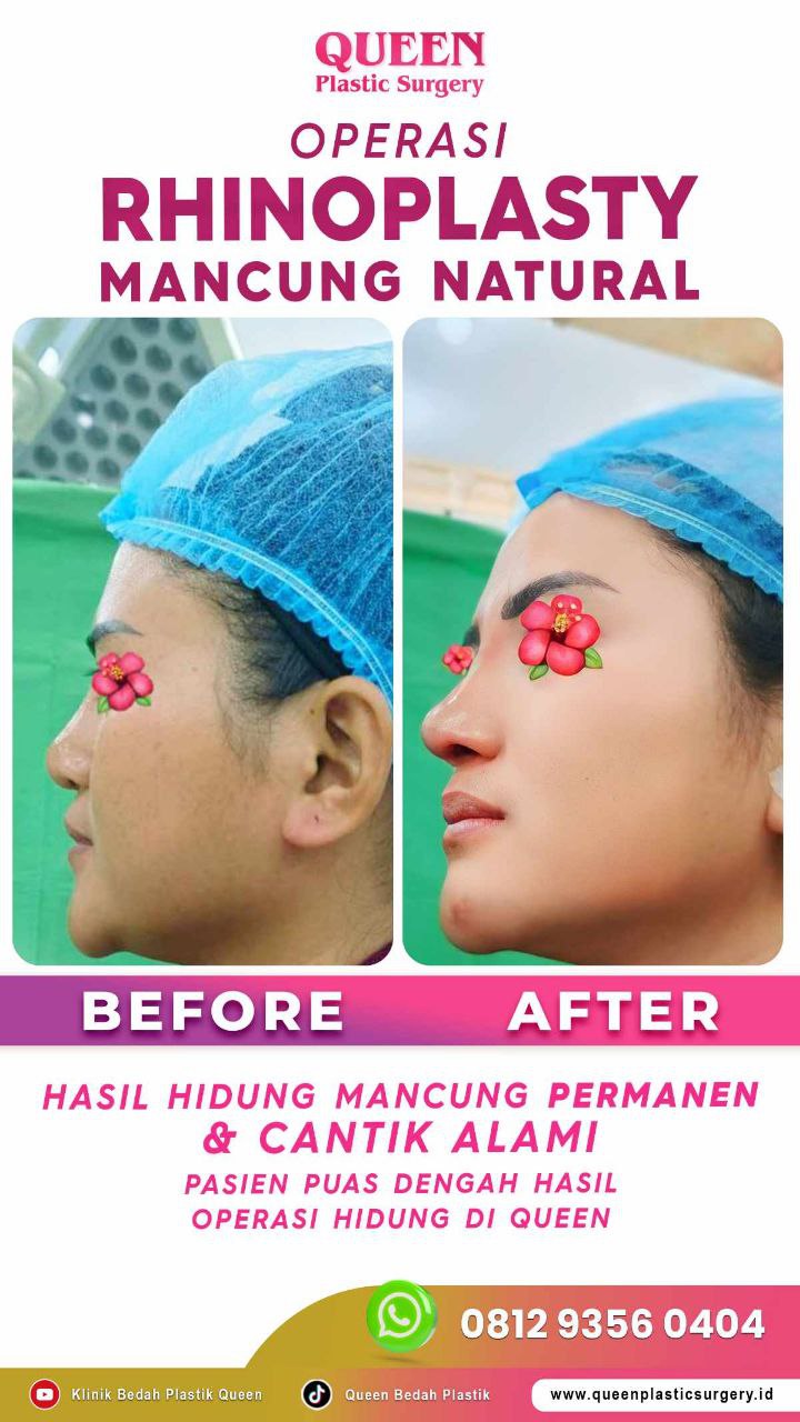 Hasil Rhinoplasty Queen Plastic Surgery, foto 70