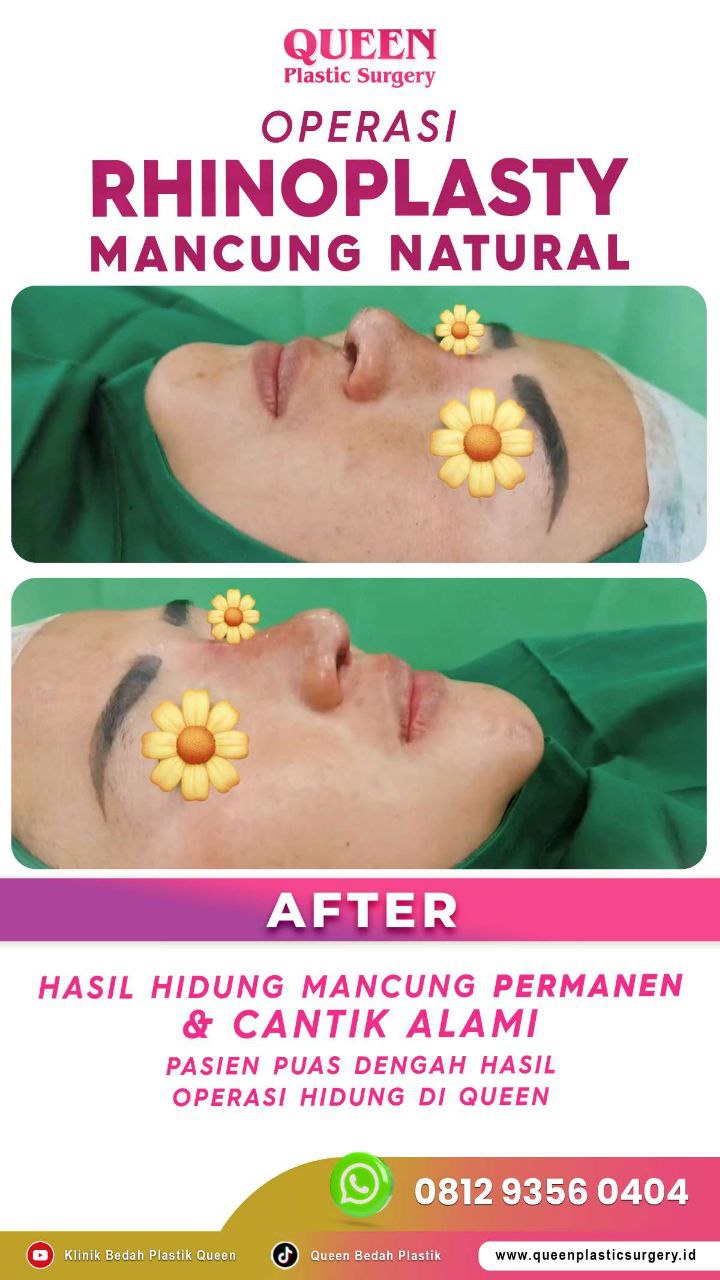 Hasil Rhinoplasty Queen Plastic Surgery, foto 69