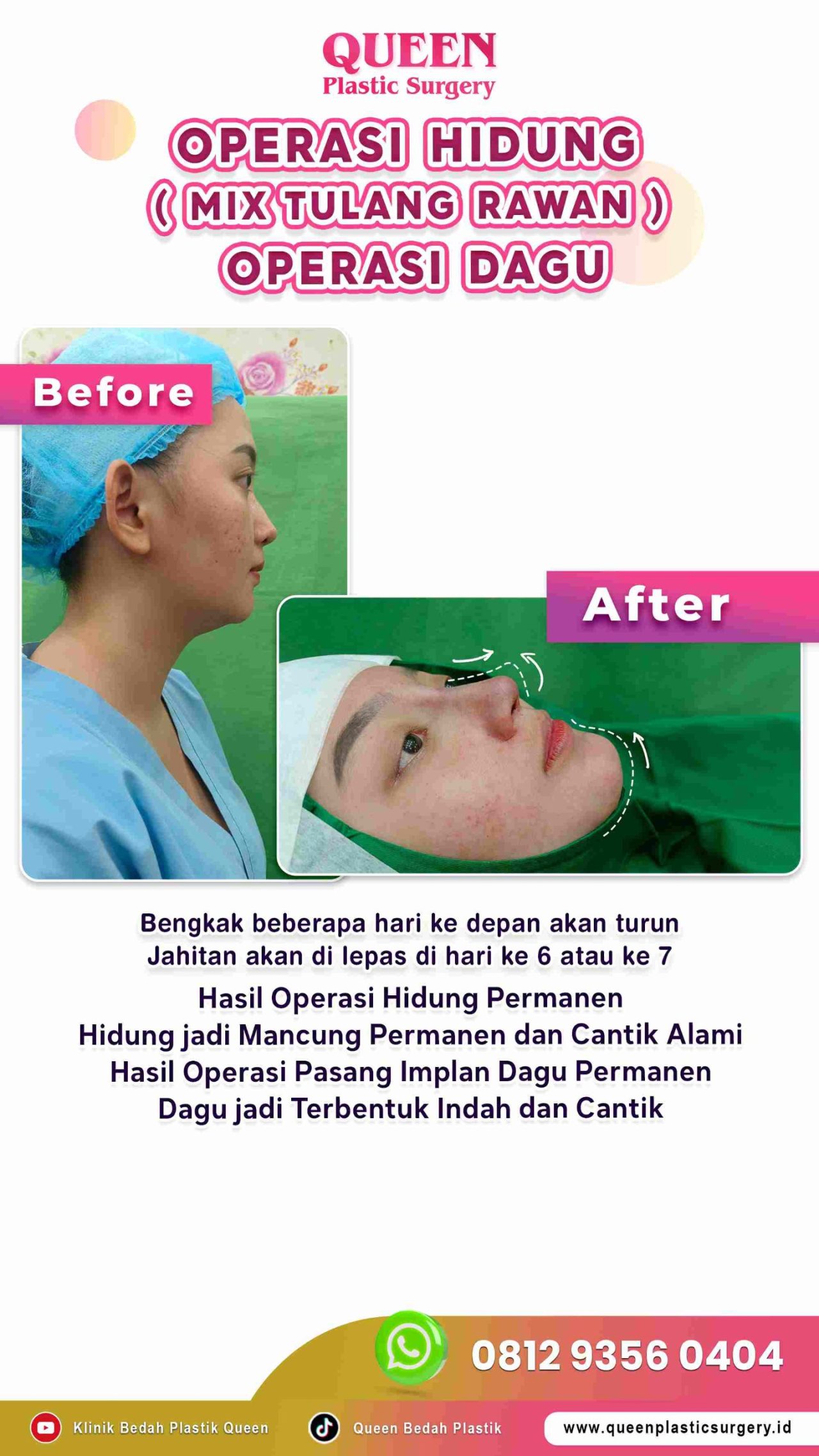 Hasil Rhinoplasty Queen Plastic Surgery, foto 52