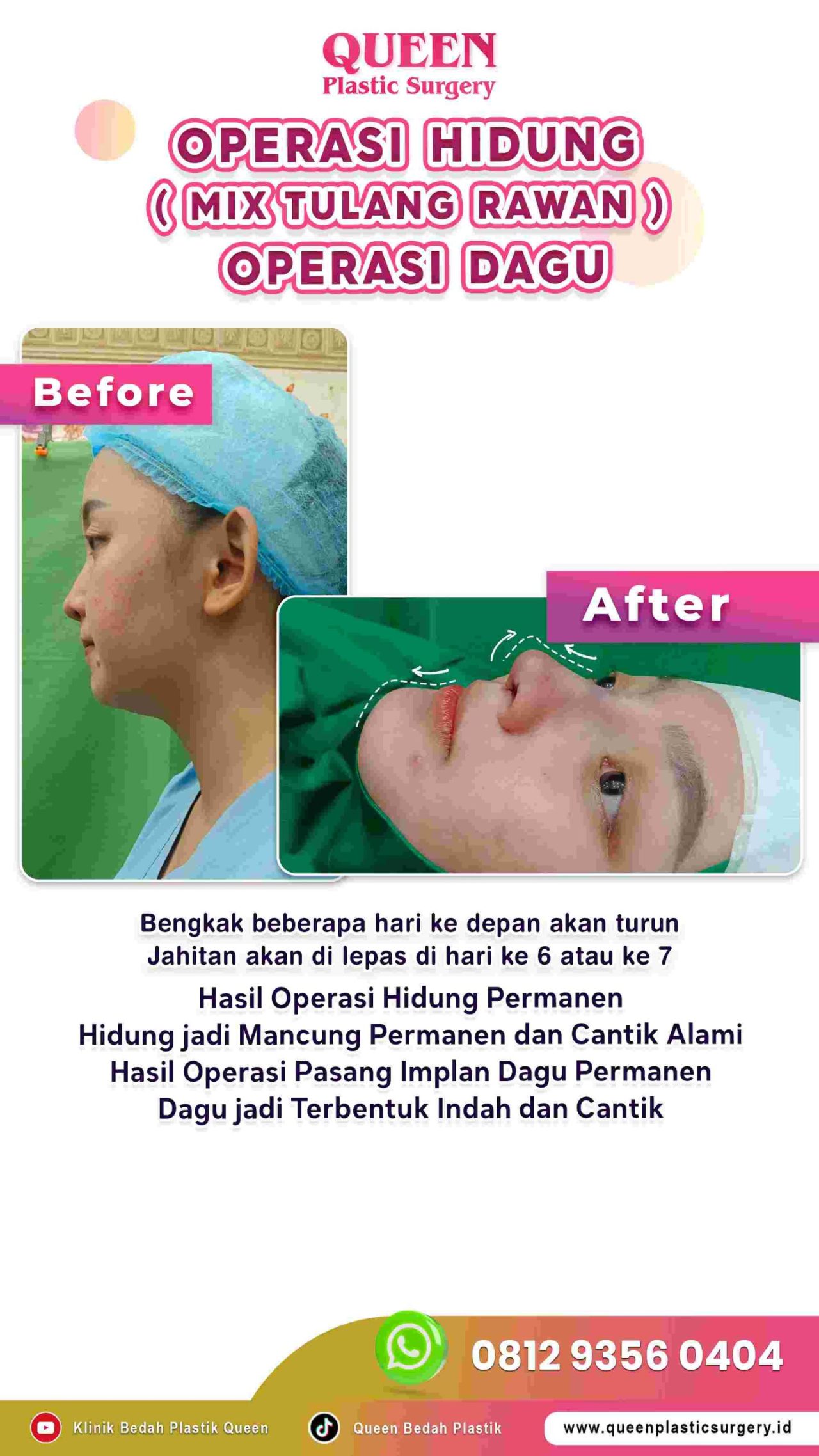 Hasil Rhinoplasty Queen Plastic Surgery, foto 53
