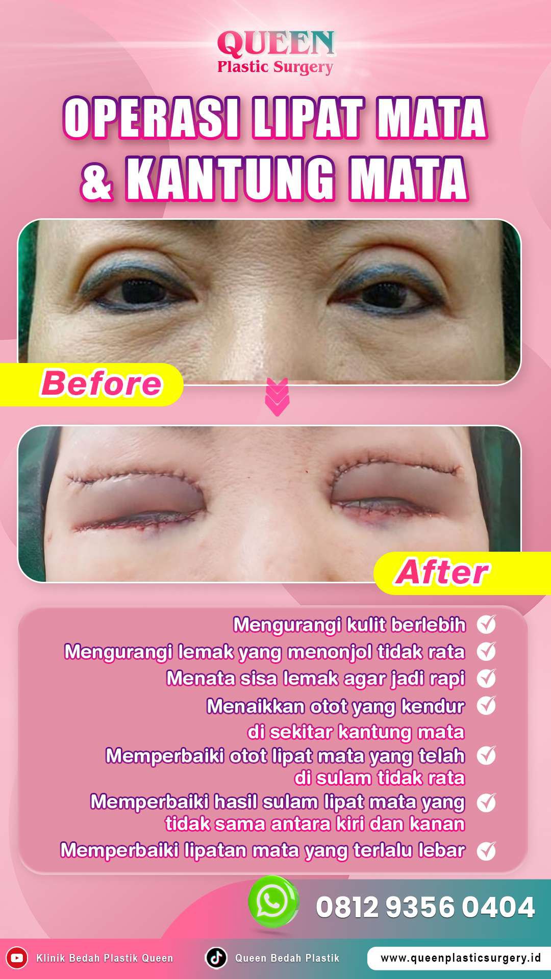 Hasil Blepharoplasty Queen Plastic Surgery, foto 3