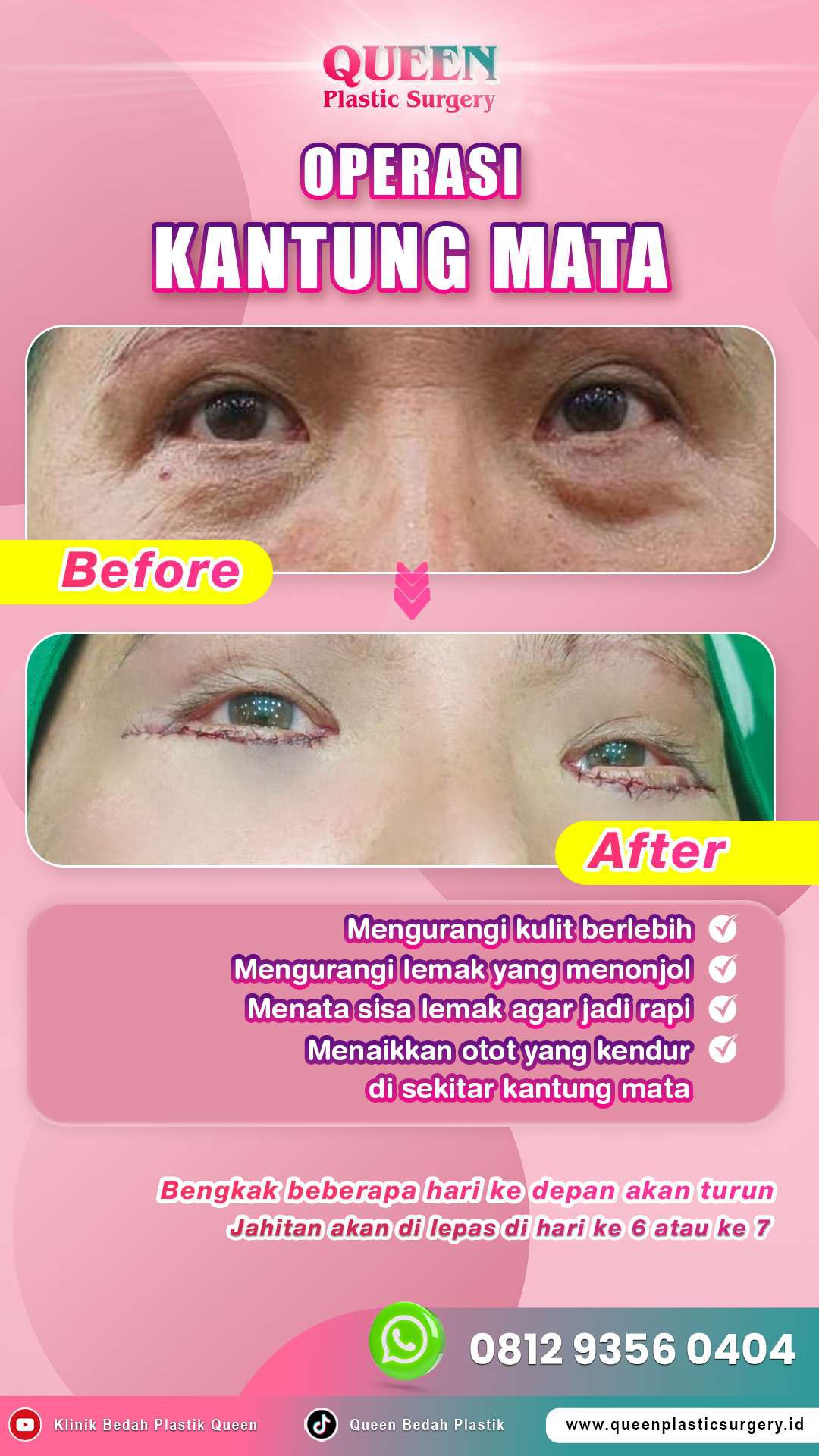 Hasil Blepharoplasty Queen Plastic Surgery, foto 4