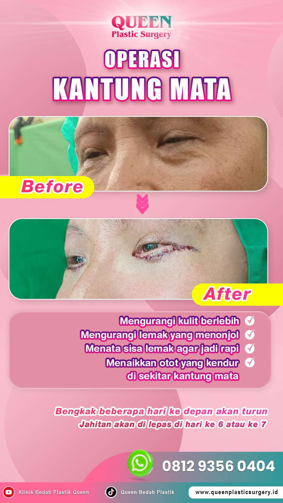 Hasil Rhinoplasty Queen Plastic Surgery, foto 34