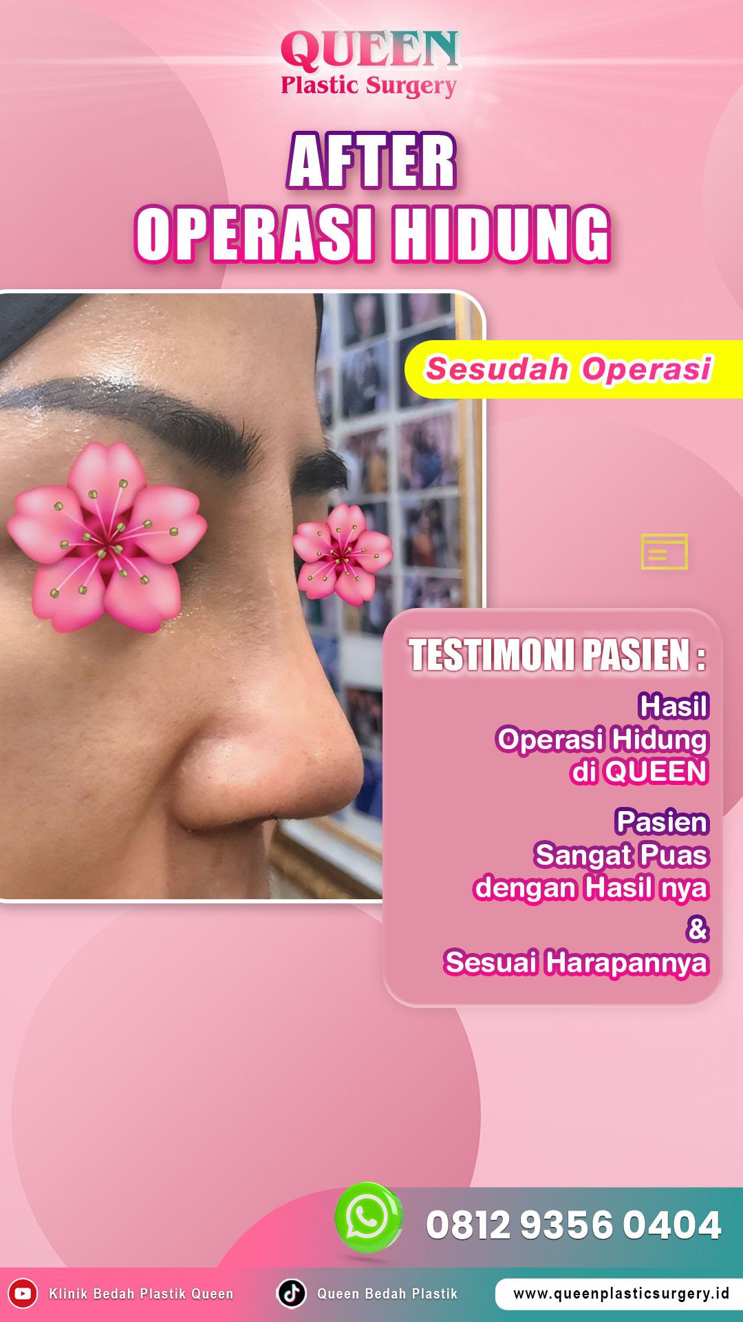 Hasil Rhinoplasty Queen Plastic Surgery, foto 35