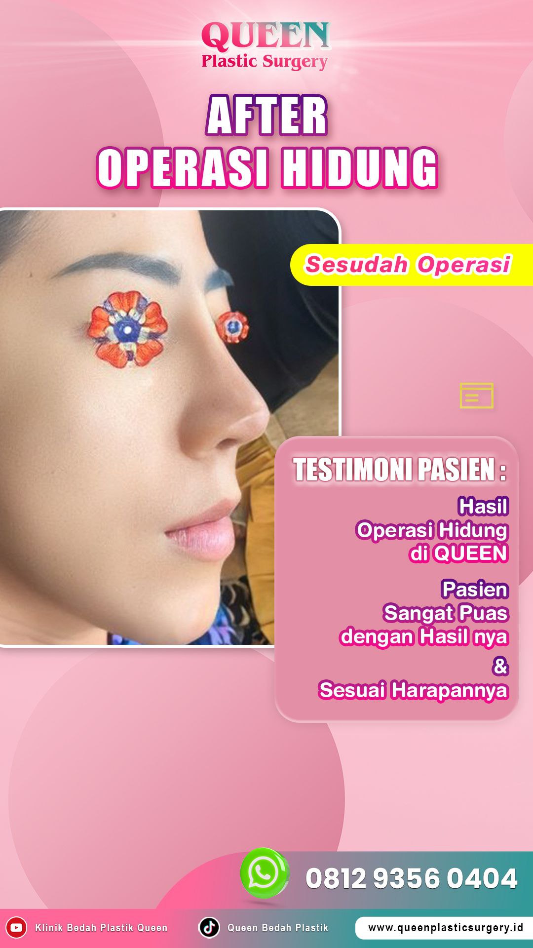 Hasil Rhinoplasty Queen Plastic Surgery, foto 43