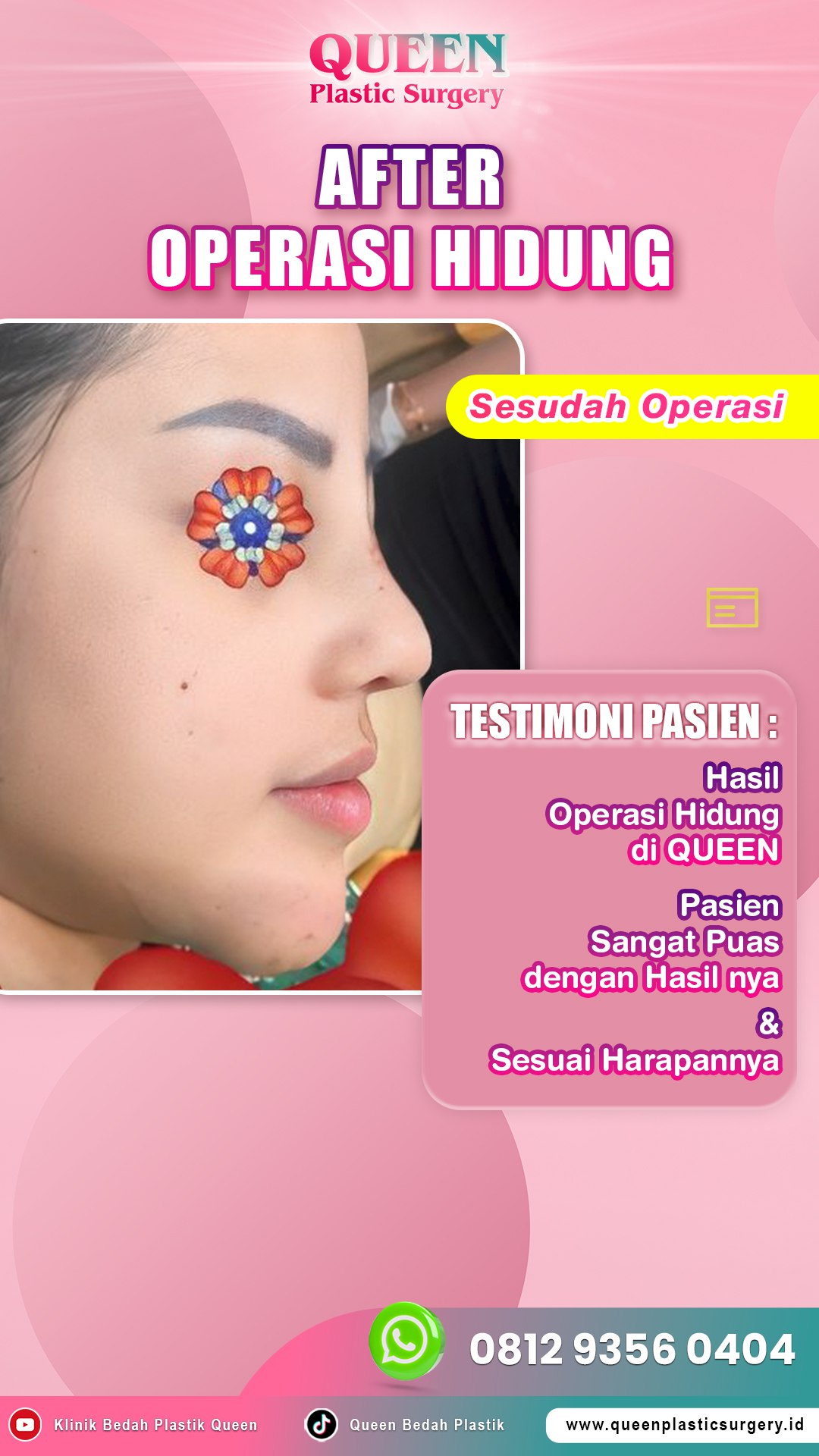 Hasil Rhinoplasty Queen Plastic Surgery, foto 50