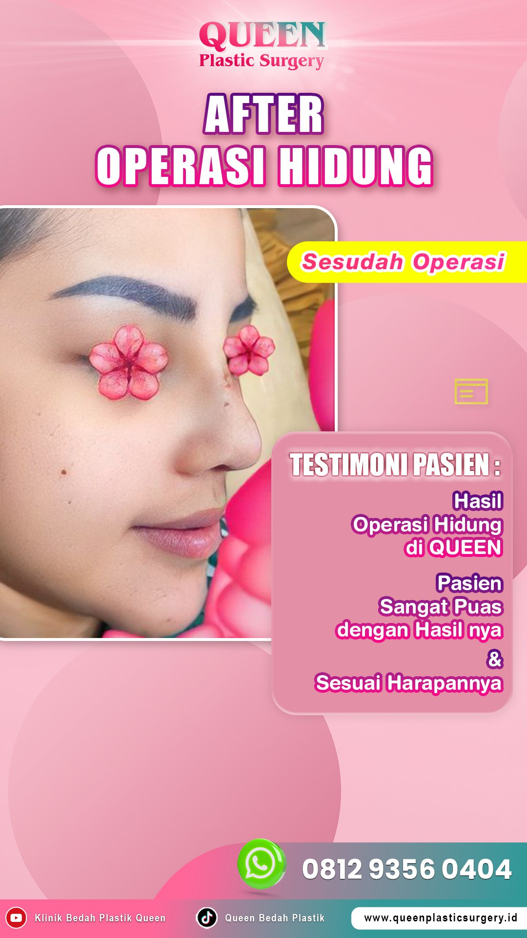 Hasil Rhinoplasty Queen Plastic Surgery, foto 51