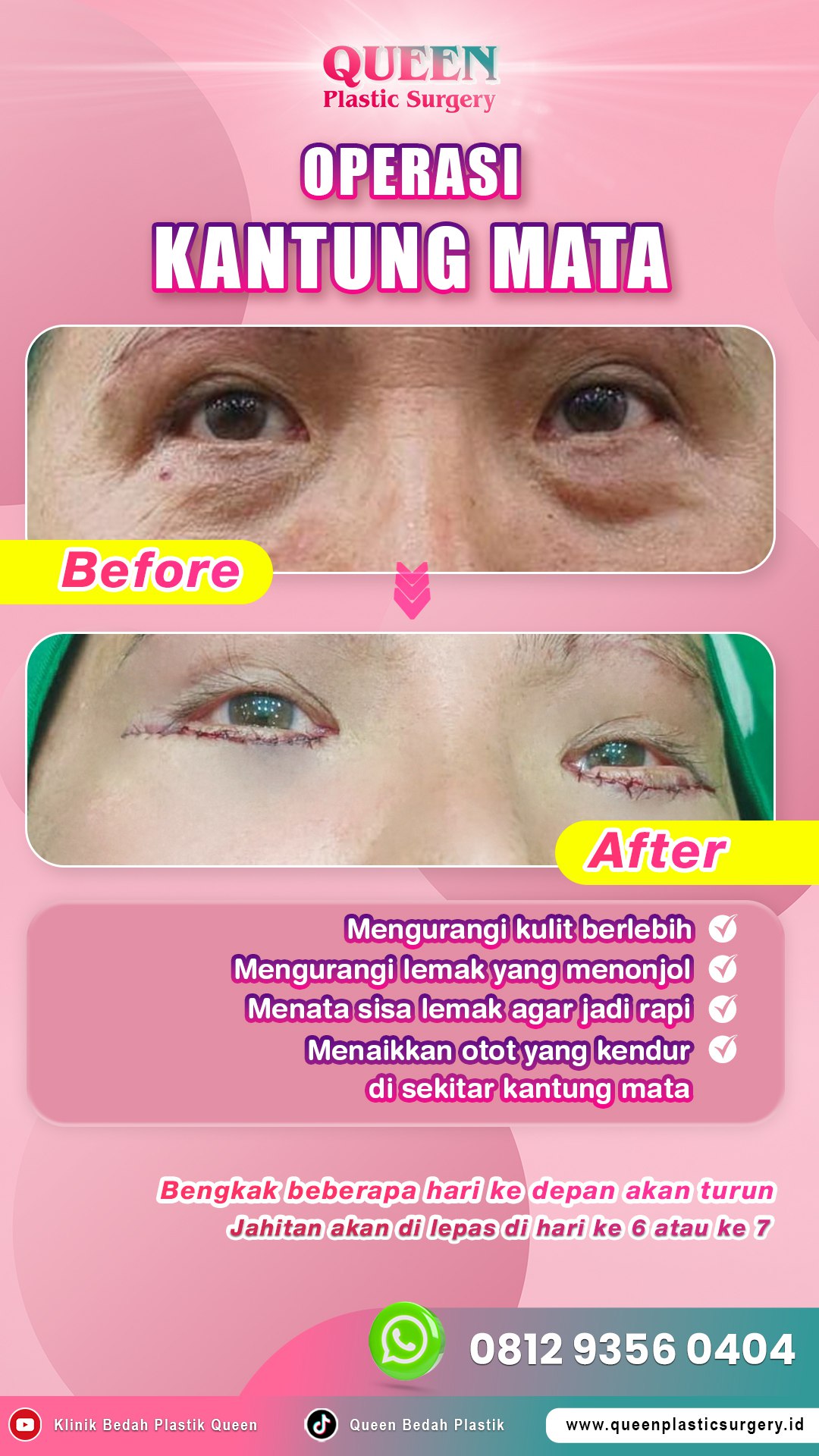 Hasil Blepharoplasty Queen Plastic Surgery, foto 1