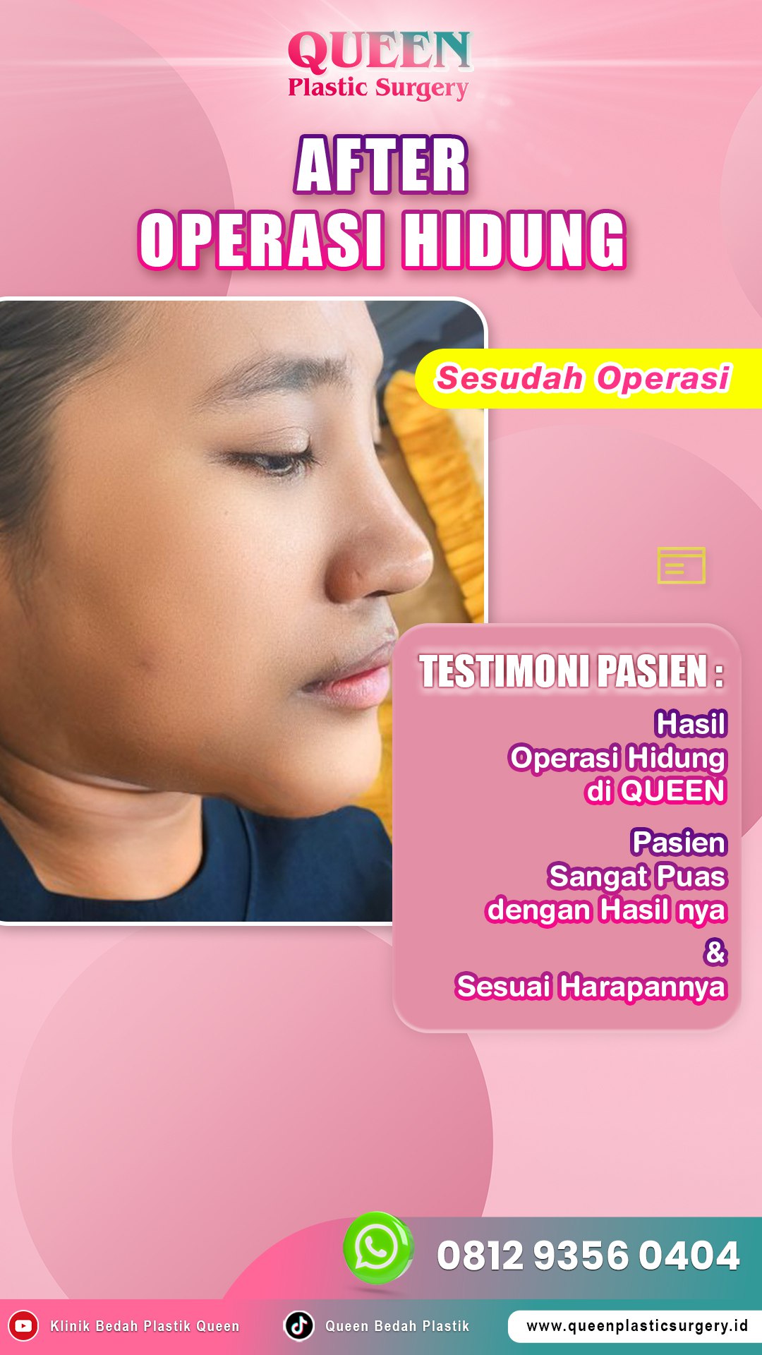 Hasil Rhinoplasty Queen Plastic Surgery, foto 39