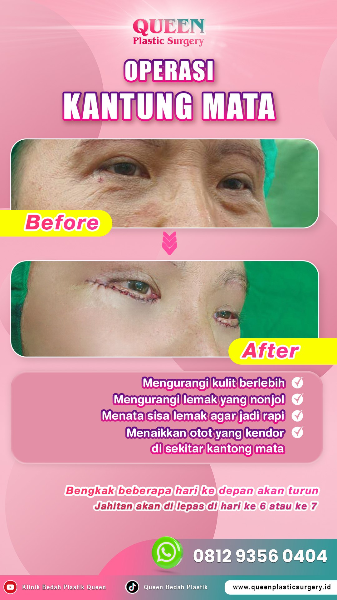 Hasil Blepharoplasty Queen Plastic Surgery, foto 6