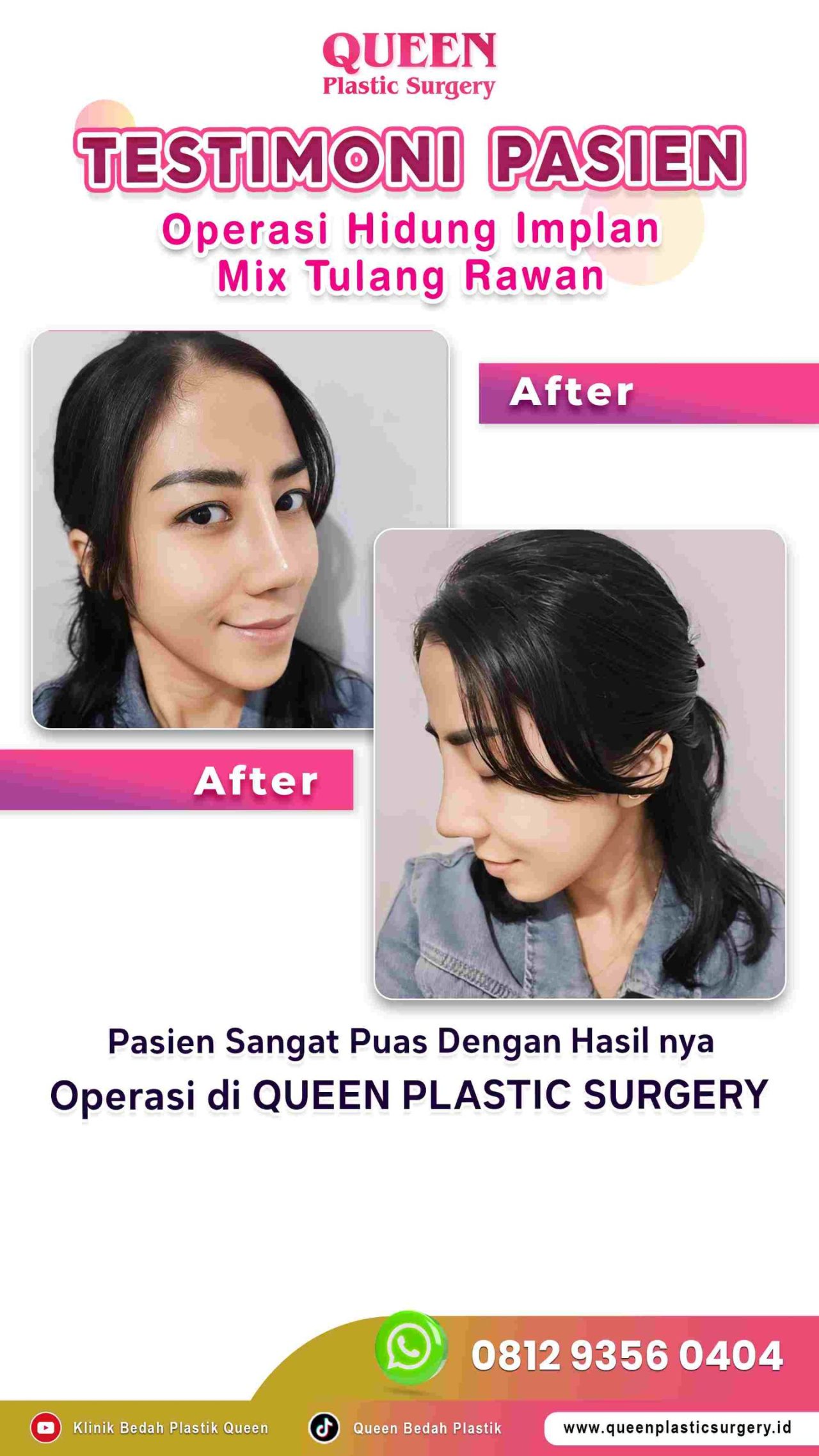 Hasil Rhinoplasty Queen Plastic Surgery, foto 41