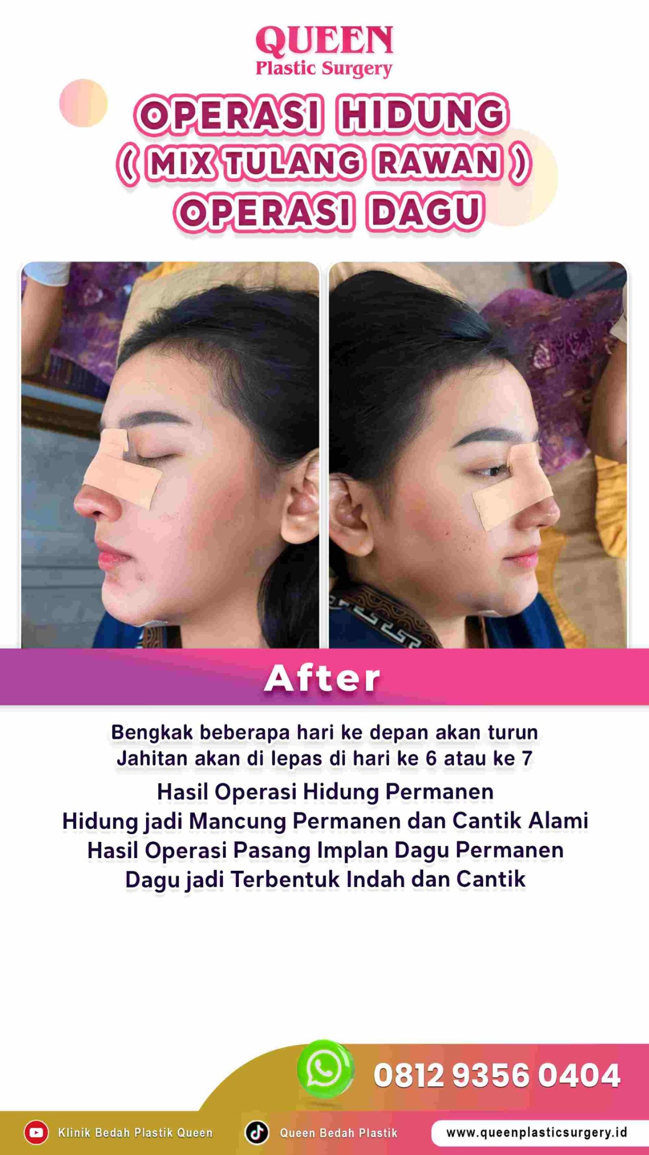 Hasil Rhinoplasty Queen Plastic Surgery, foto 42