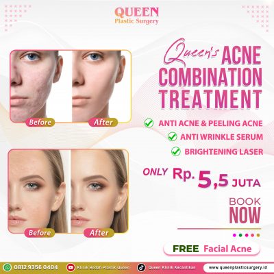 Queen's-Acne-Combination-Treatment