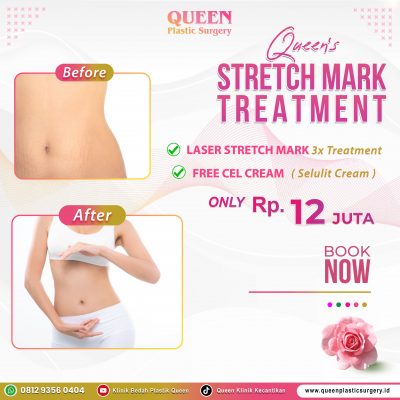 Queen's-Stretch-Mark-Treatment